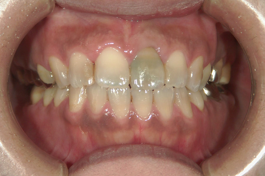 神経のない歯のホワイトニング
